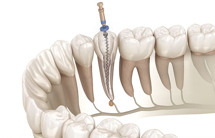 大切な歯を守る精密な根管治療