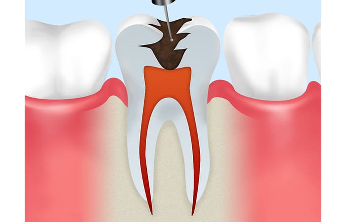 汚染歯質の除去