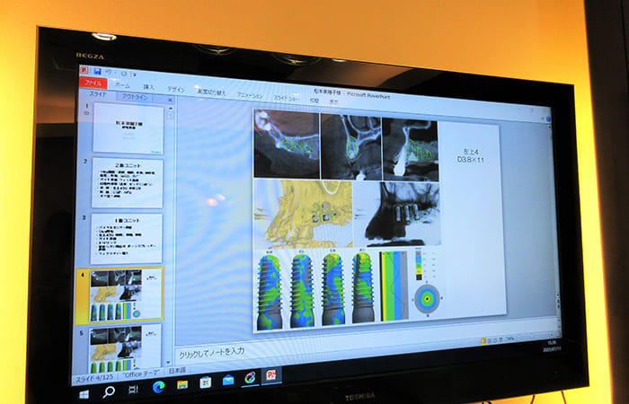 歯科用CTを使用した高精度のインプラント治療