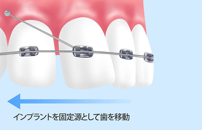 アンカースクリュー（矯正用インプラント）