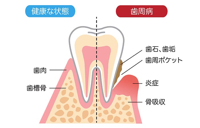 歯を失う原因となる歯周病