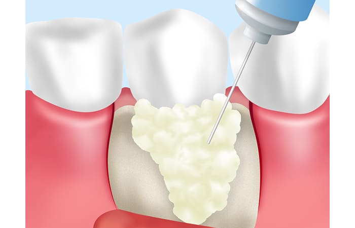 歯周再生治療について
