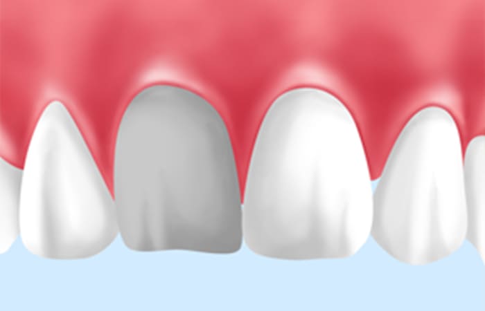 神経のない歯を白くする治療