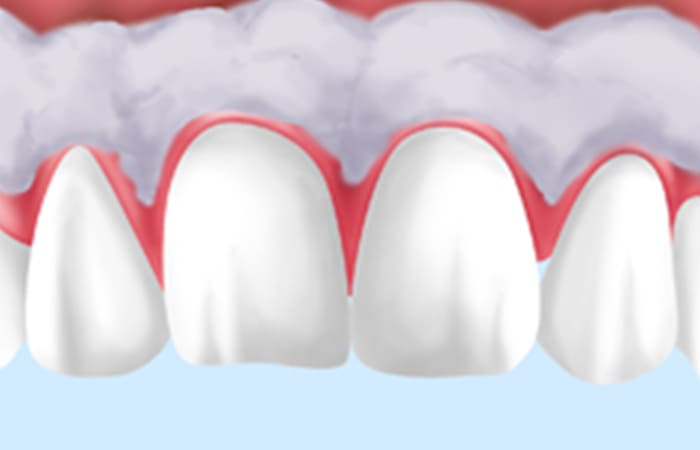 歯ぐきの黒ずみを改善する治療