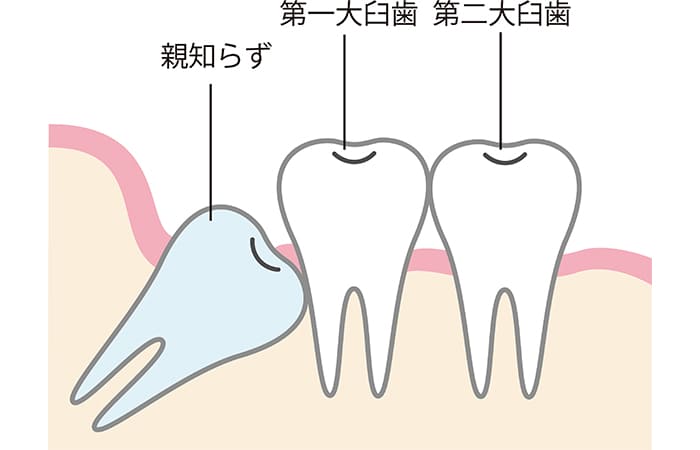 抜歯した方が良いケース