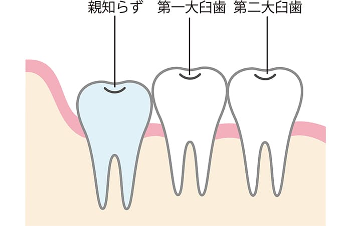 抜歯しなくても良いケース