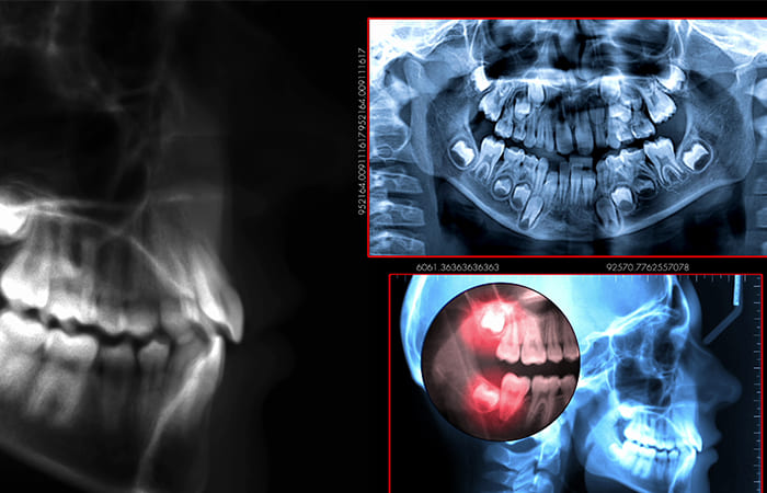 歯科用CTによる精密診断で安全性の高い抜歯
